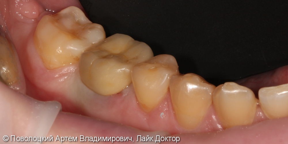 Покрытие зуба 46 коронкой безметалловой по технологии E-max - фото №8