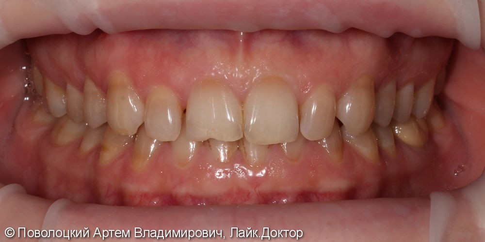 Виниры E-max на верхние зубы с клыка по клык - фото №2