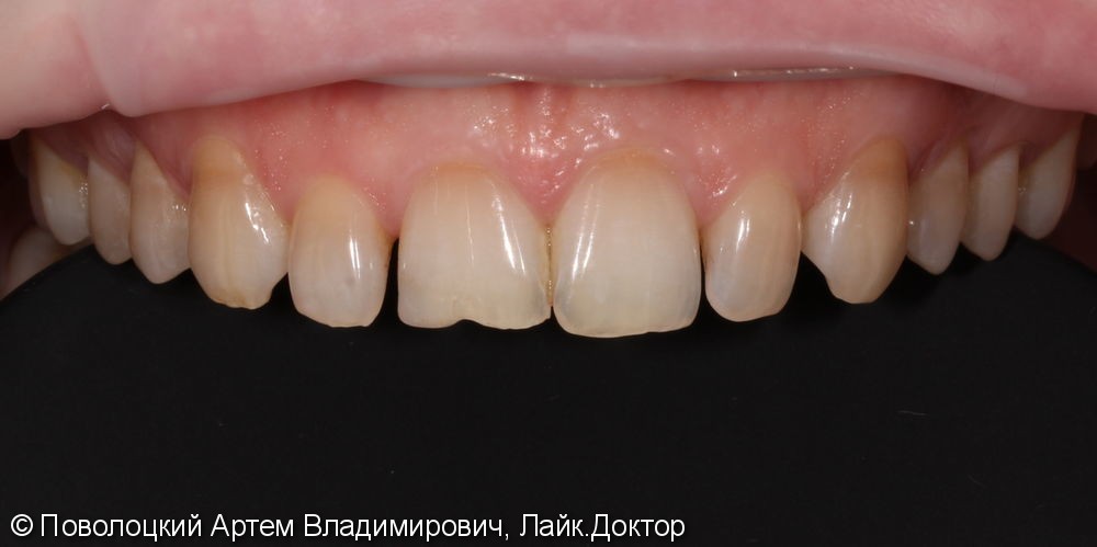 Виниры E-max на верхние зубы с клыка по клык - фото №3