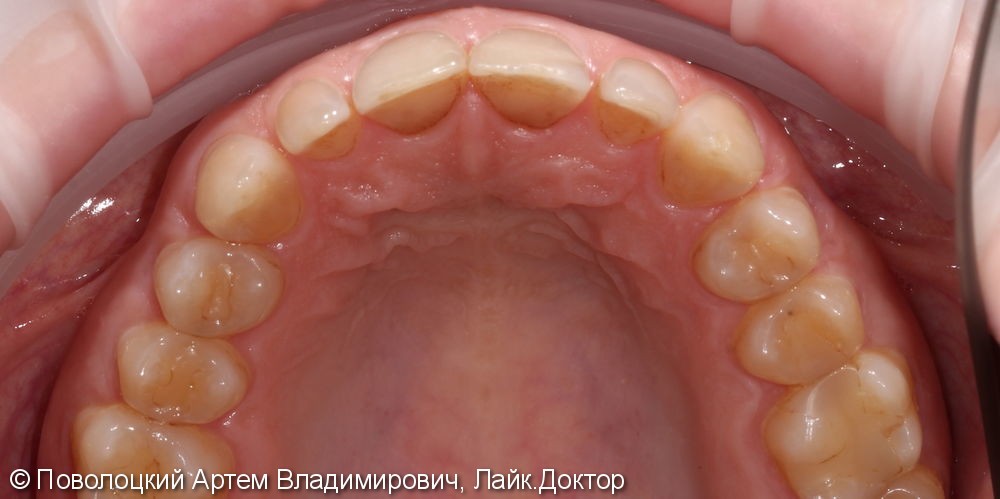 Виниры E-max на верхние зубы с клыка по клык - фото №4