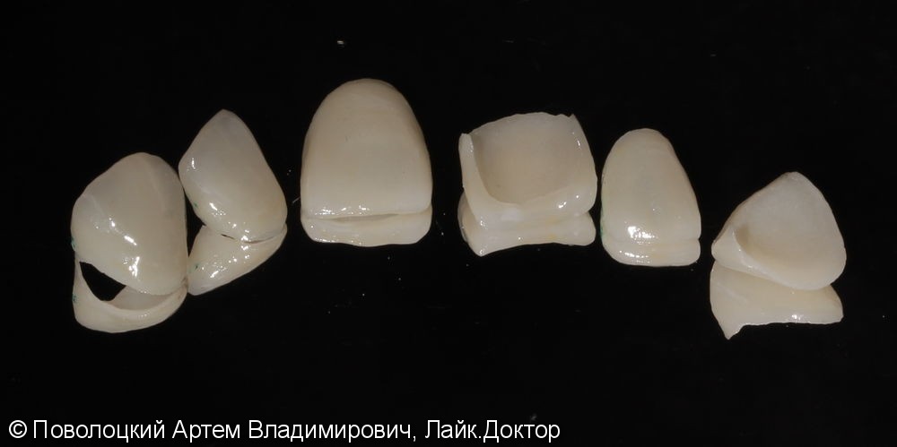 Виниры E-max на верхние зубы с клыка по клык - фото №5
