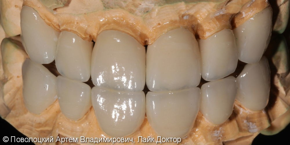 Виниры E-max на верхние зубы с клыка по клык - фото №6