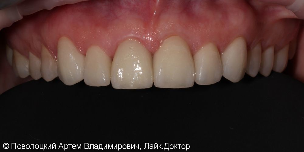 Виниры E-max на верхние зубы с клыка по клык - фото №7