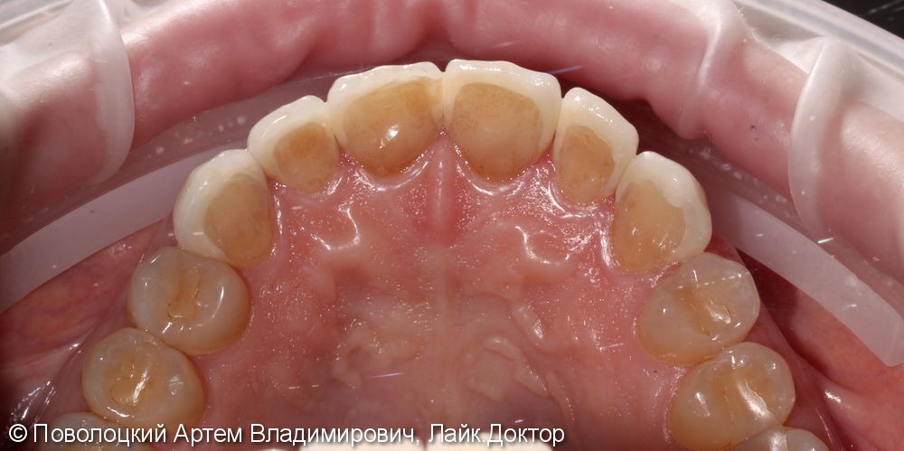 Виниры E-max на верхние зубы с клыка по клык - фото №8