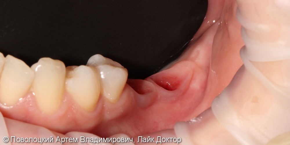 имплантация Осстем 36,37 зубы, коронки из оксида циркония с вестибулярной облицовкой - фото №1