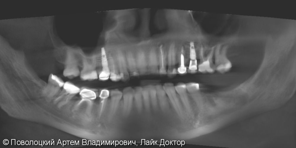 имплантация Осстем 36,37 зубы, коронки из оксида циркония с вестибулярной облицовкой - фото №2