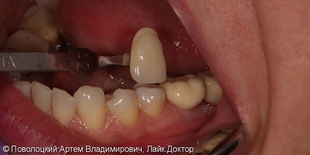 имплантация Осстем 36,37 зубы, коронки из оксида циркония с вестибулярной облицовкой - фото №3