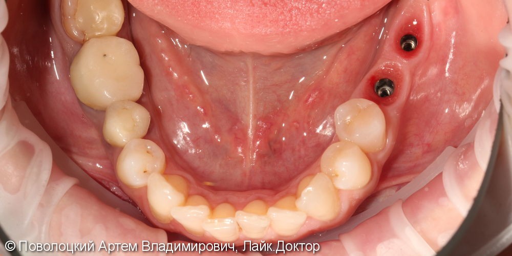 имплантация Осстем 36,37 зубы, коронки из оксида циркония с вестибулярной облицовкой - фото №4