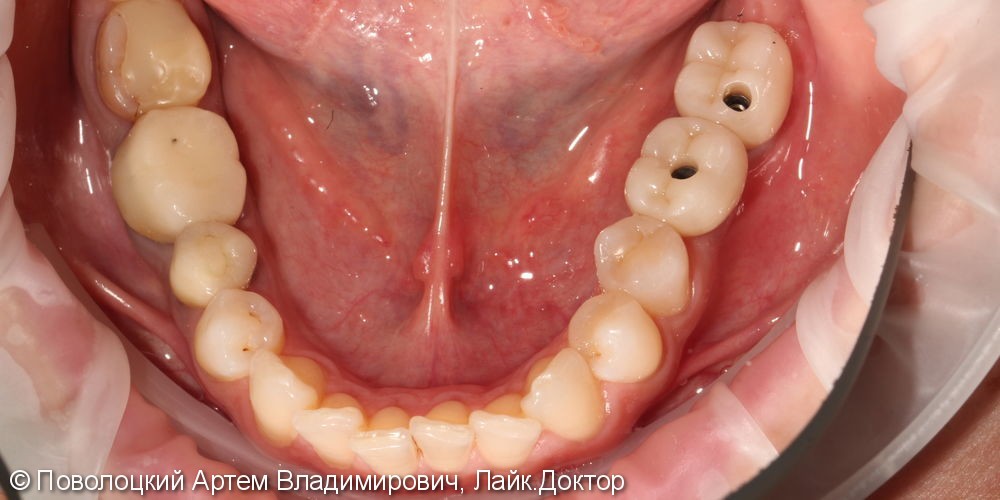 имплантация Осстем 36,37 зубы, коронки из оксида циркония с вестибулярной облицовкой - фото №5
