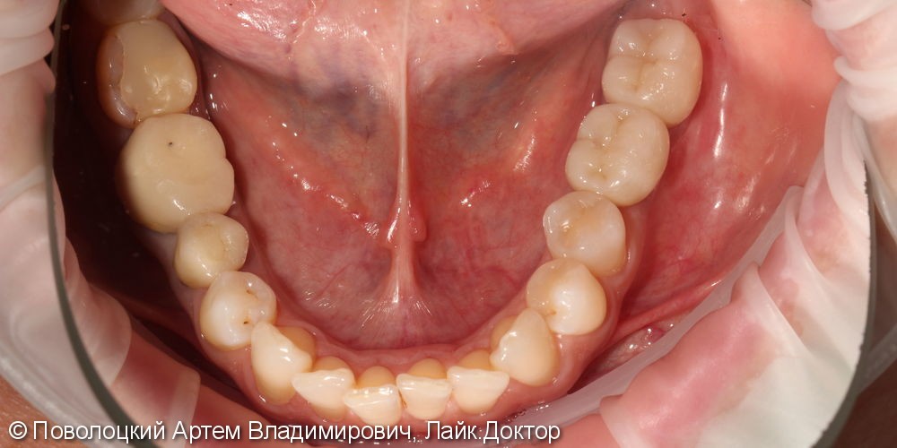 имплантация Осстем 36,37 зубы, коронки из оксида циркония с вестибулярной облицовкой - фото №6