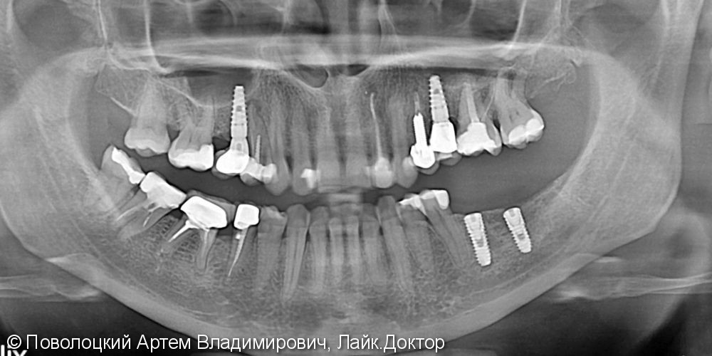имплантация Осстем 36,37 зубы, коронки из оксида циркония с вестибулярной облицовкой - фото №7