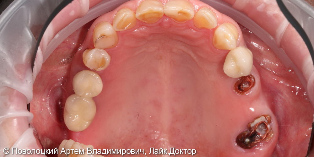 Удаление зубов на верхней челюсти с одномоментной имплантацией Osstem и открытым синус лифтингом - фото №1