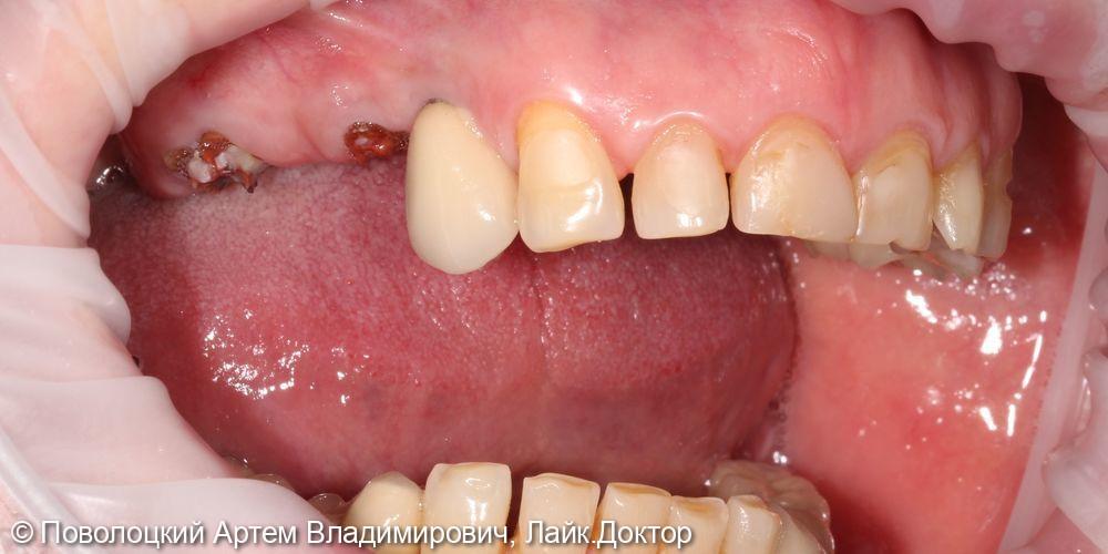 Удаление зубов на верхней челюсти с одномоментной имплантацией Osstem и открытым синус лифтингом - фото №2