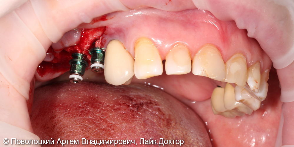 Удаление зубов на верхней челюсти с одномоментной имплантацией Osstem и открытым синус лифтингом - фото №5