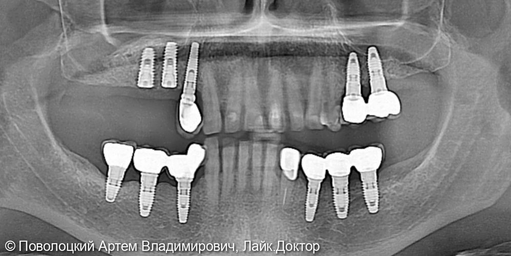 Удаление зубов на верхней челюсти с одномоментной имплантацией Osstem и открытым синус лифтингом - фото №6