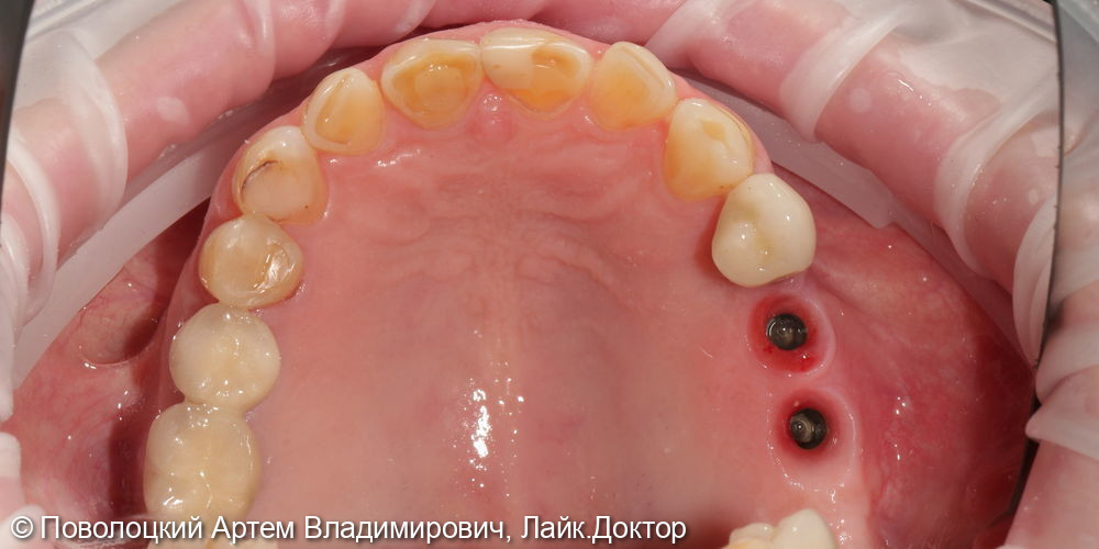 Удаление зубов на верхней челюсти с одномоментной имплантацией Osstem и открытым синус лифтингом - фото №7