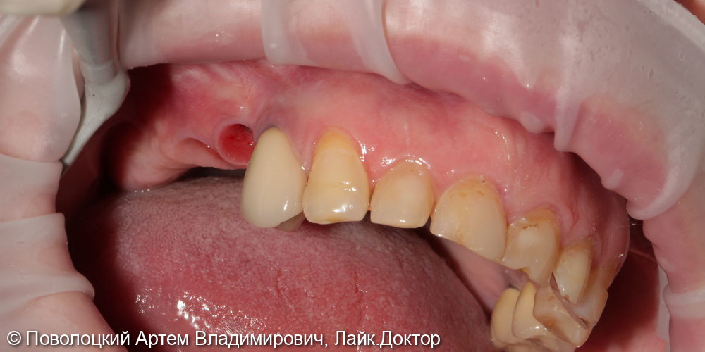 Удаление зубов на верхней челюсти с одномоментной имплантацией Osstem и открытым синус лифтингом - фото №8