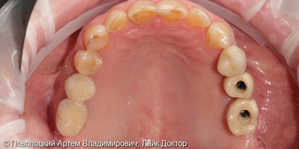 Удаление зубов на верхней челюсти с одномоментной имплантацией Osstem и открытым синус лифтингом - фото №9