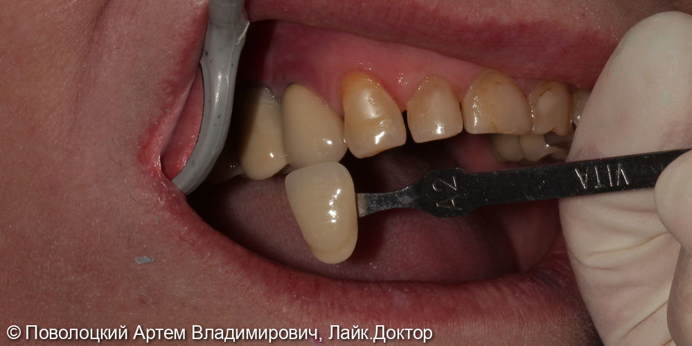 Удаление зубов на верхней челюсти с одномоментной имплантацией Osstem и открытым синус лифтингом - фото №10