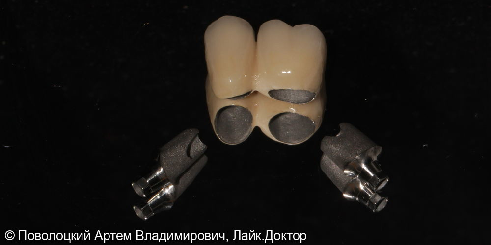 Удаление зубов на верхней челюсти с одномоментной имплантацией Osstem и открытым синус лифтингом - фото №11