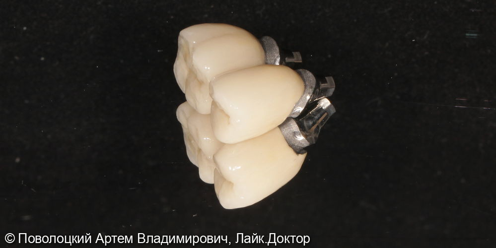 Удаление зубов на верхней челюсти с одномоментной имплантацией Osstem и открытым синус лифтингом - фото №12