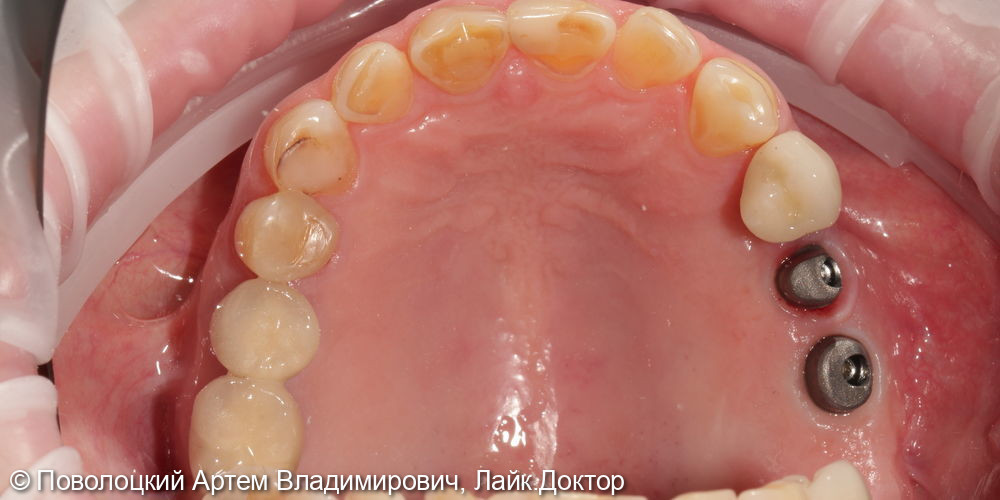 Удаление зубов на верхней челюсти с одномоментной имплантацией Osstem и открытым синус лифтингом - фото №13