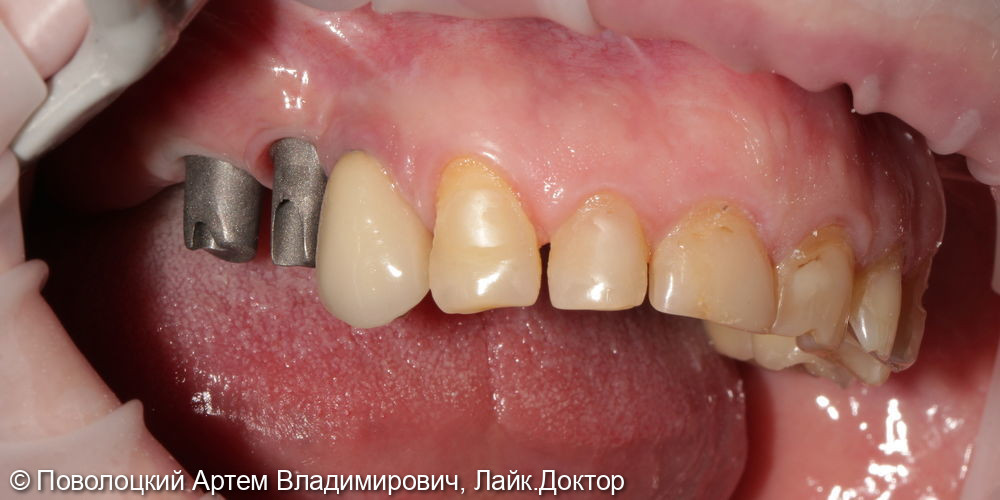 Удаление зубов на верхней челюсти с одномоментной имплантацией Osstem и открытым синус лифтингом - фото №14