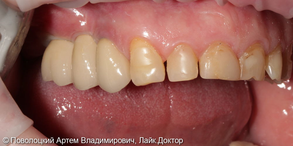 Удаление зубов на верхней челюсти с одномоментной имплантацией Osstem и открытым синус лифтингом - фото №15