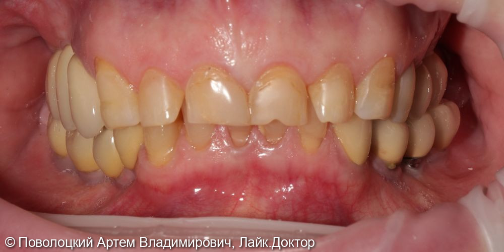 Удаление зубов на верхней челюсти с одномоментной имплантацией Osstem и открытым синус лифтингом - фото №16
