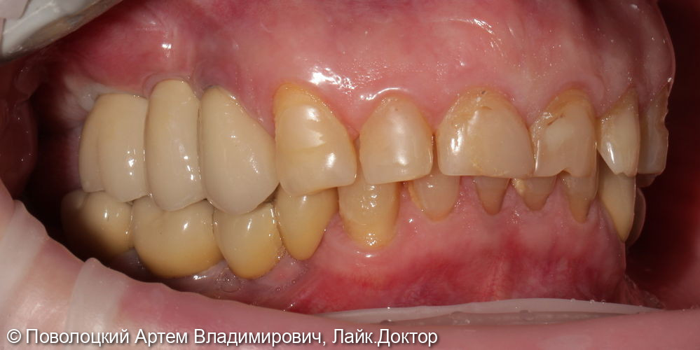 Удаление зубов на верхней челюсти с одномоментной имплантацией Osstem и открытым синус лифтингом - фото №17