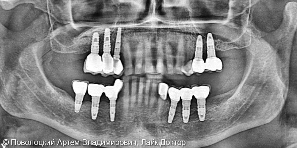 Удаление зубов на верхней челюсти с одномоментной имплантацией Osstem и открытым синус лифтингом - фото №18