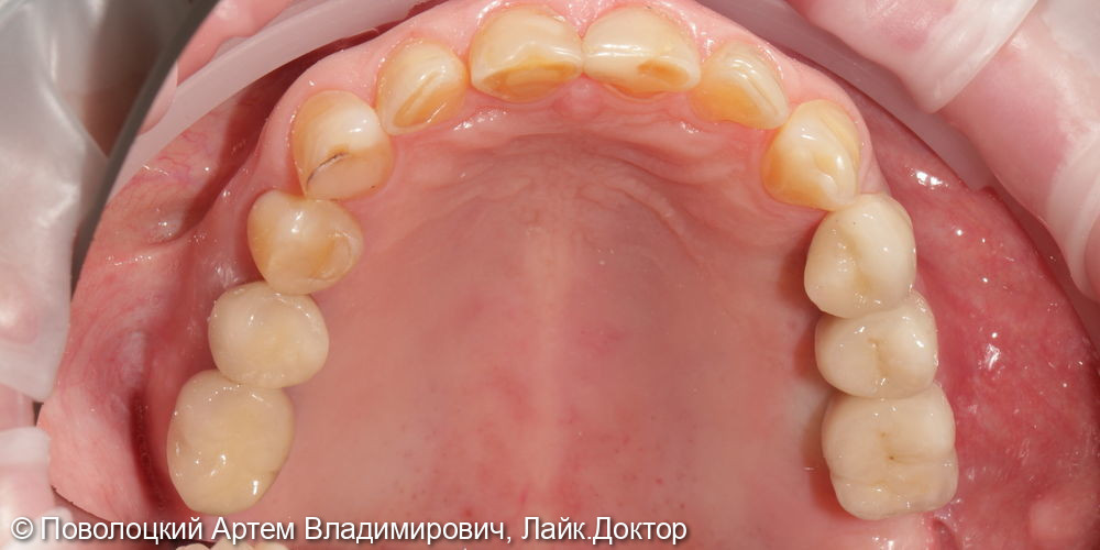 Удаление зубов на верхней челюсти с одномоментной имплантацией Osstem и открытым синус лифтингом - фото №19