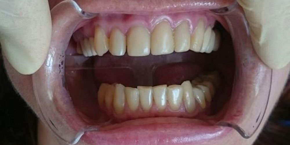 Эстетическая реабилитация фронтальной группы зубов винирами IPS e.max - фото №1