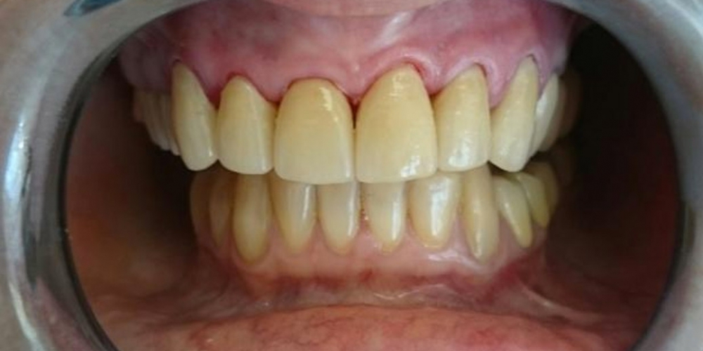 Эстетическая реабилитация фронтальной группы зубов винирами IPS e.max - фото №2