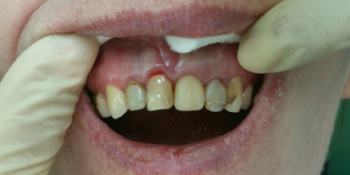 Композитная реставрация 6 фронтальных зубов верхней челюсти - фото №1