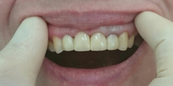 Композитная реставрация 6 фронтальных зубов верхней челюсти - фото №2