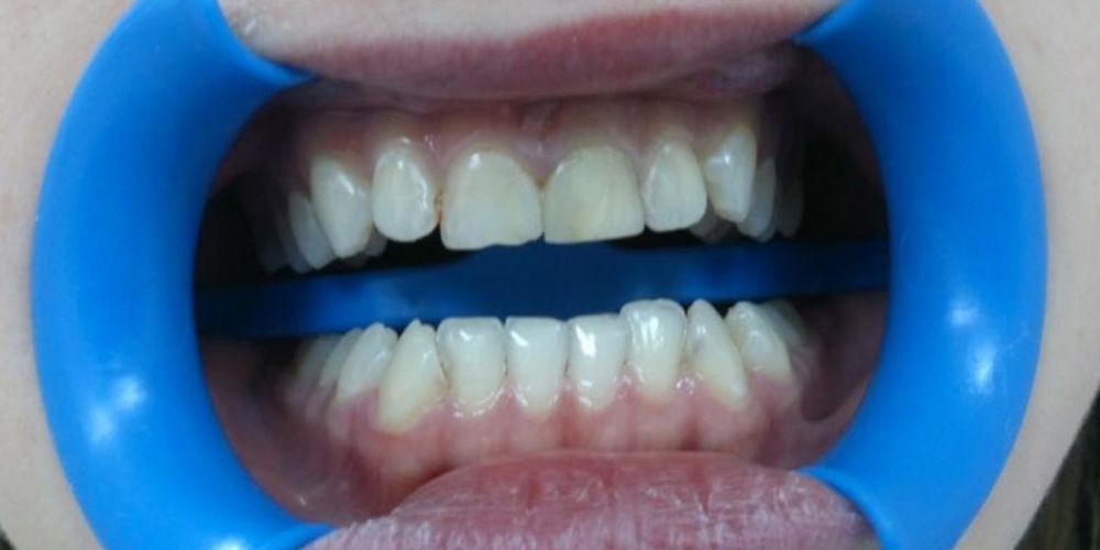 Эстетическая реабилитация фронтальных зубов с пластикой десневого края - фото №1