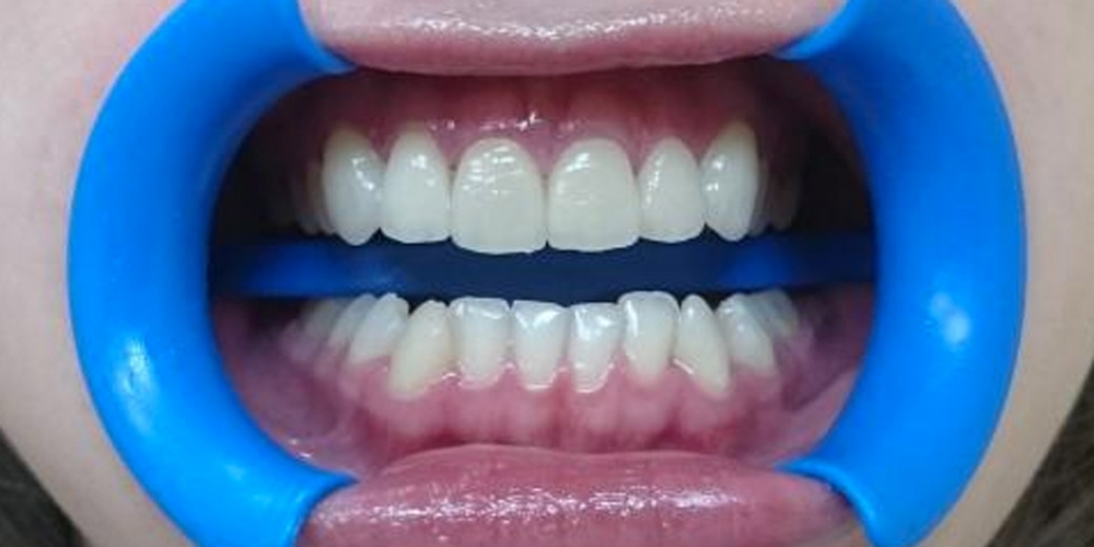 Эстетическая реабилитация фронтальных зубов с пластикой десневого края - фото №2