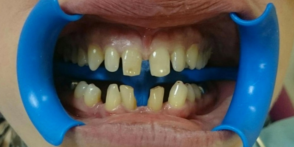 Полная реконструкции фронтальной группы зубов верхней и нижней челюсти безметалловыми конструкциями - фото №1