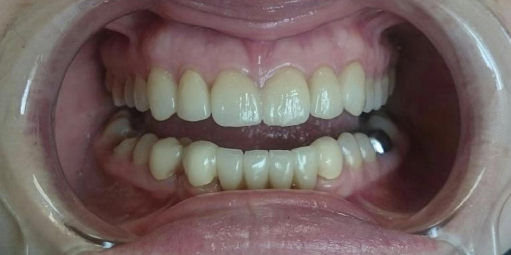 Полная реконструкции фронтальной группы зубов верхней и нижней челюсти безметалловыми конструкциями - фото №2