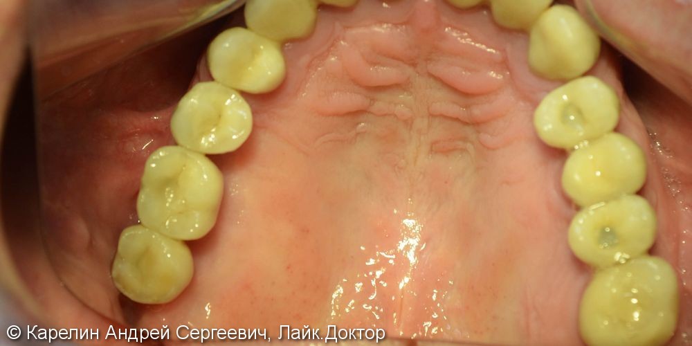 Полная реконструкция зубочелюстной системы с помощью имплантатов и металлокерамических коронок - фото №5