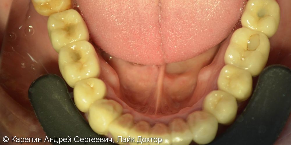 Полная реконструкция зубочелюстной системы с помощью имплантатов и металлокерамических коронок - фото №6