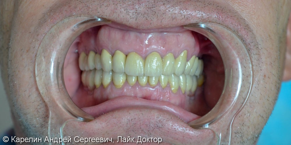 Полная реконструкция зубочелюстной системы с помощью имплантатов и металлокерамических коронок - фото №8