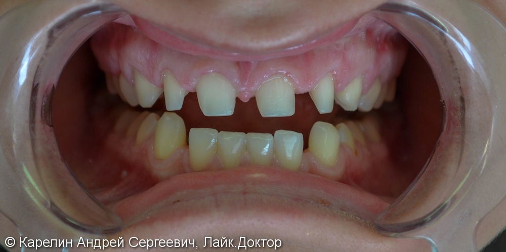 Закрытие трем и диастемы  во фронтальном отделе зубного ряда с помощью виниров E.max - фото №1