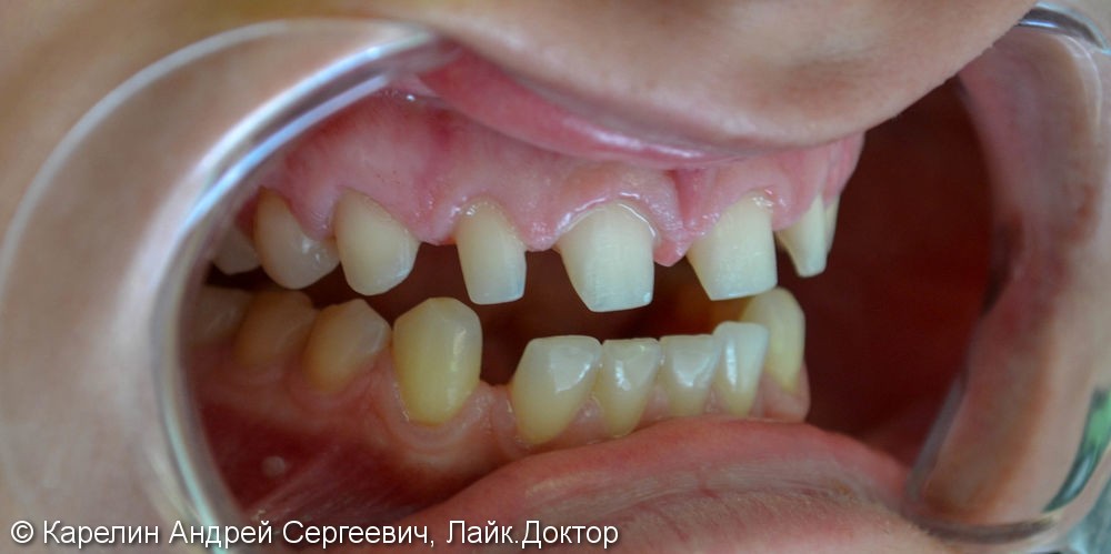 Закрытие трем и диастемы  во фронтальном отделе зубного ряда с помощью виниров E.max - фото №2