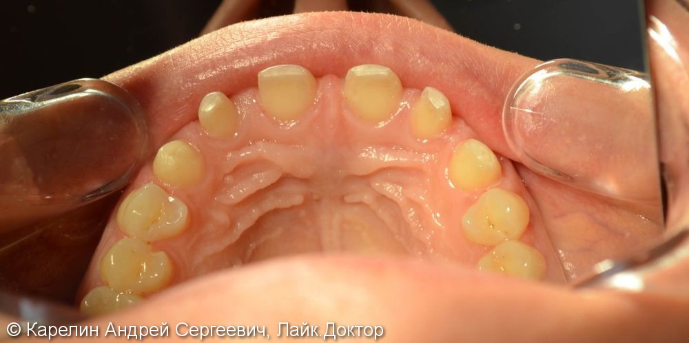Закрытие трем и диастемы  во фронтальном отделе зубного ряда с помощью виниров E.max - фото №3