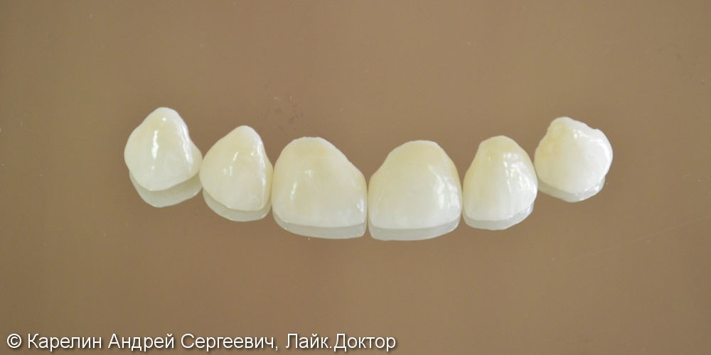 Закрытие трем и диастемы  во фронтальном отделе зубного ряда с помощью виниров E.max - фото №4