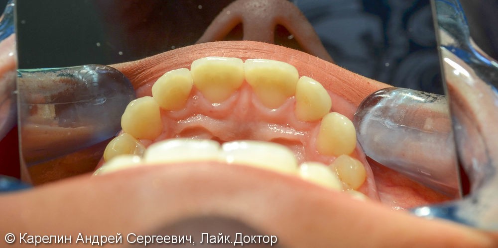 Закрытие трем и диастемы  во фронтальном отделе зубного ряда с помощью виниров E.max - фото №5
