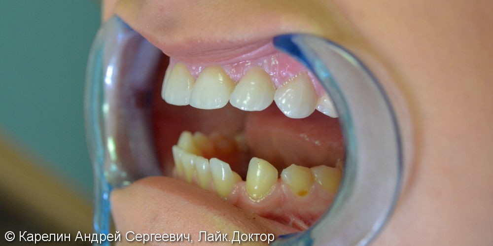 Закрытие трем и диастемы  во фронтальном отделе зубного ряда с помощью виниров E.max - фото №7