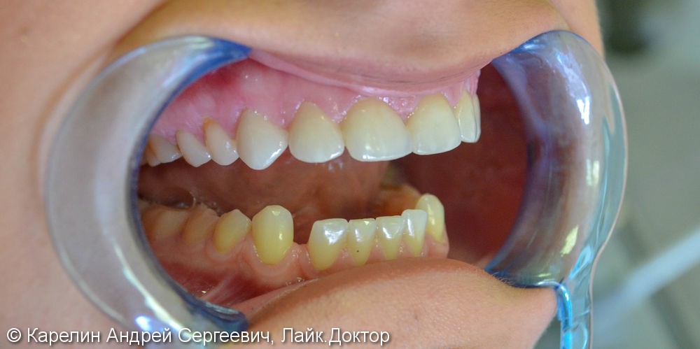 Закрытие трем и диастемы  во фронтальном отделе зубного ряда с помощью виниров E.max - фото №8